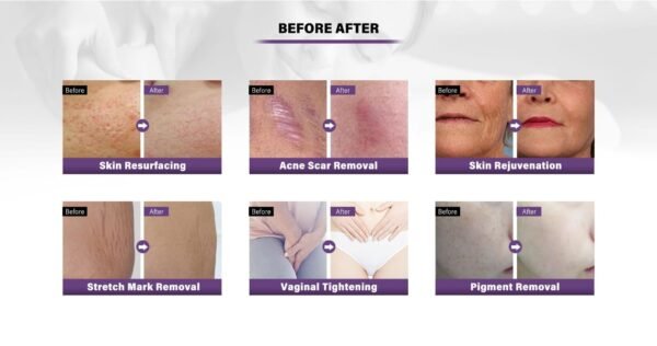 Vertical CO₂ Fractional Laser Machine